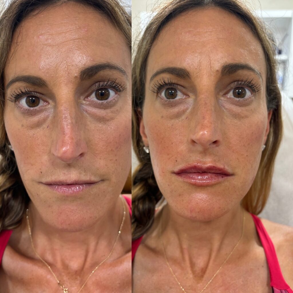 lip filler naples