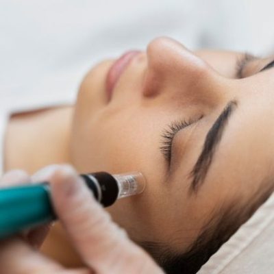 microneedling naples fl